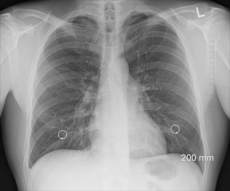 diagnosis, xray, chest